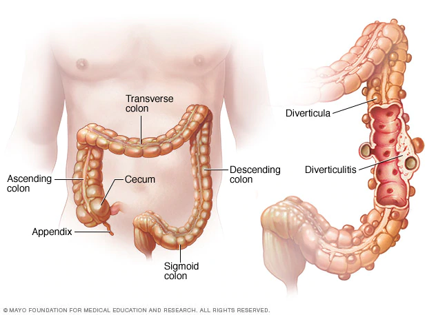 Colon diverticulitis - Hình ảnh minh họa